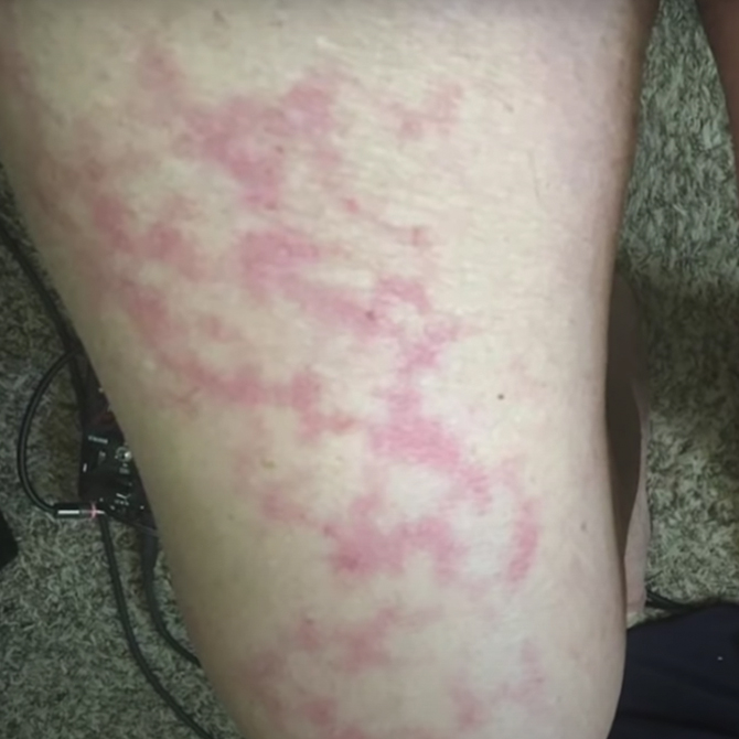 COVID-19 causes rashes: Here's what to look out for (фото 4)