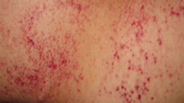 COVID-19 causes rashes: Here's what to look out for (фото 2)