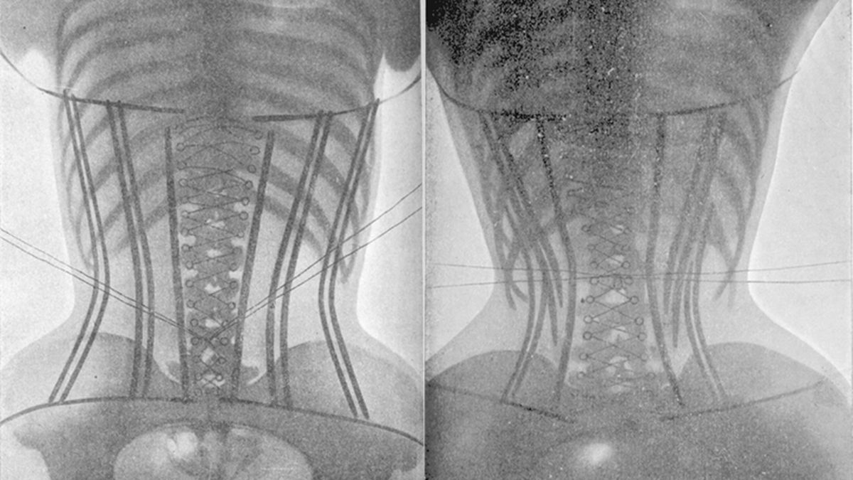 tightlacing corset xray 1908