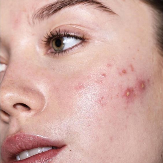 Beauty Diaries: How I (mostly) cleared my hormonal acne after 10 years (фото 4)