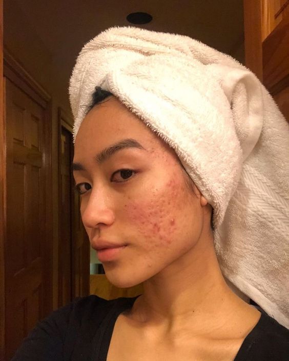 Beauty Diaries: How I (mostly) cleared my hormonal acne after 10 years (фото 9)