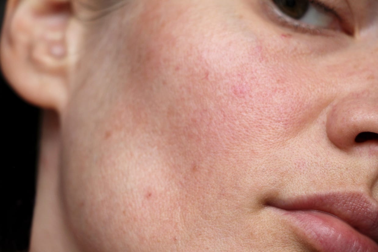 Guide to chemical exfoliants: What are they, how to use them and how much is too much? (фото 2)