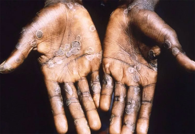 Monkeypox: What is it and should Malaysians be worried about the disease? (фото 2)