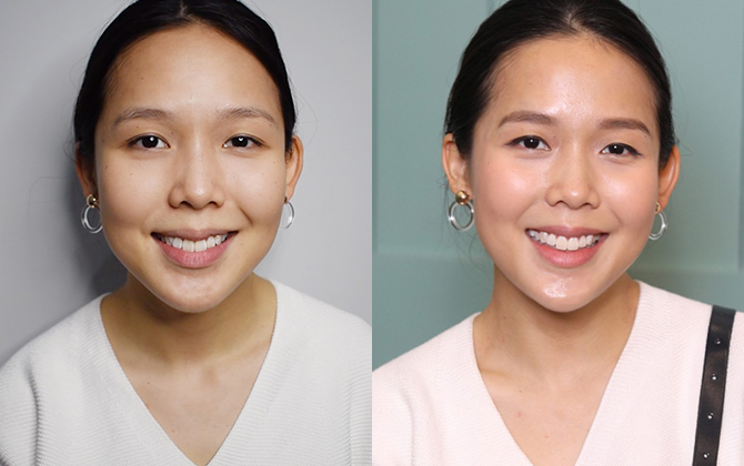 Review: Facial acupuncture, face alignment and gua sha — is it worth the pain? (фото 2)