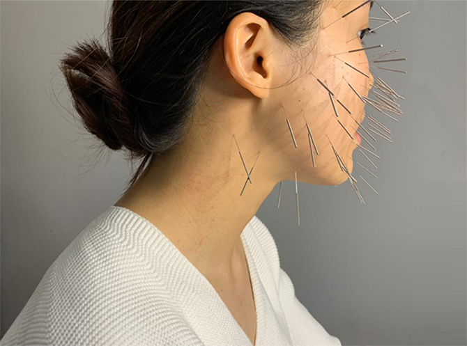 Review: Facial acupuncture, face alignment and gua sha — is it worth the pain? (фото 1)