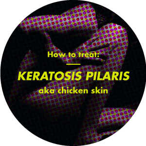 How to get rid of keratosis pilaris (chicken skin)
