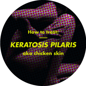 How to get rid of keratosis pilaris (chicken skin) How to get rid of keratosis pilaris (chicken skin)