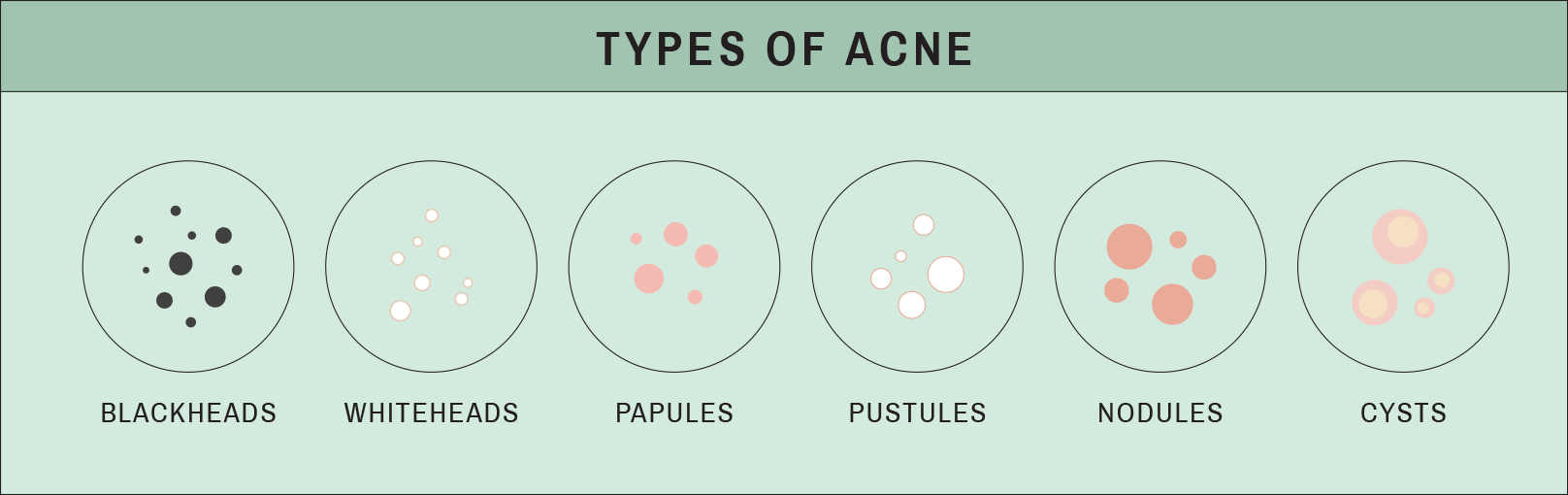 Let's talk about ACNE