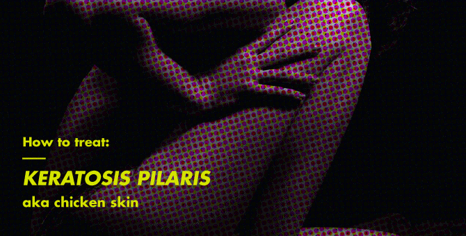How to get rid of keratosis pilaris (chicken skin)