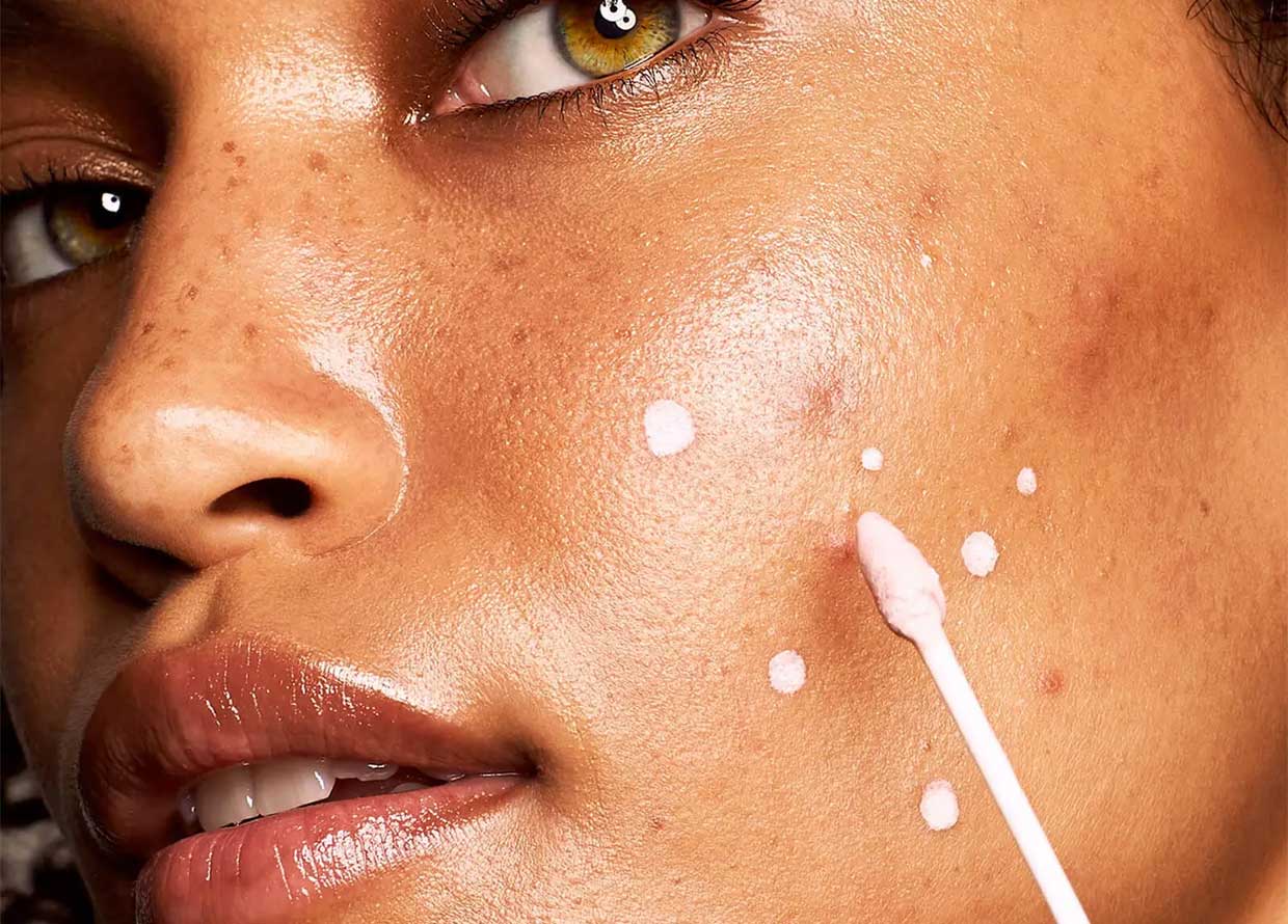 The best acne and spot treatments to help curb your breakouts