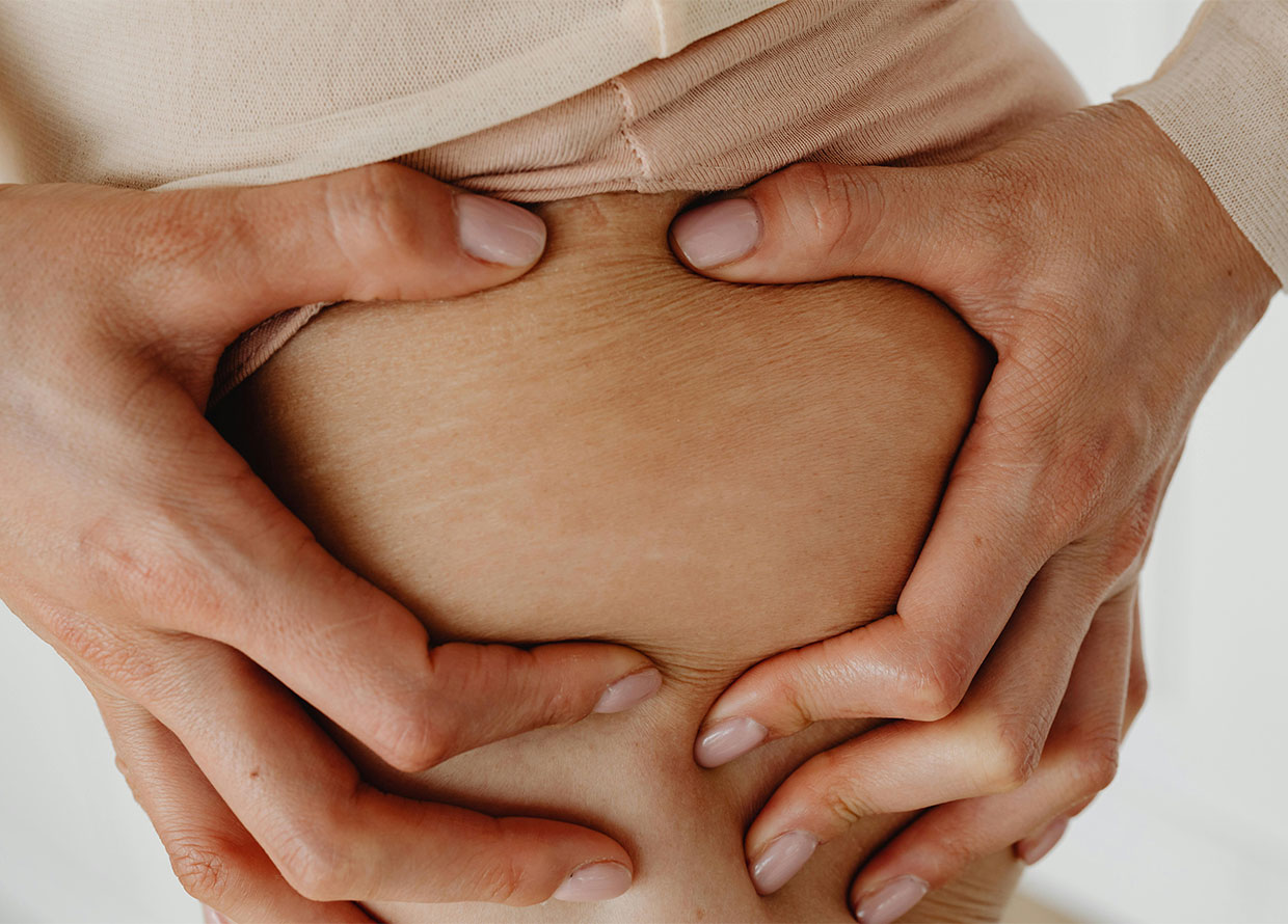 How to get rid of your unwanted stretch marks